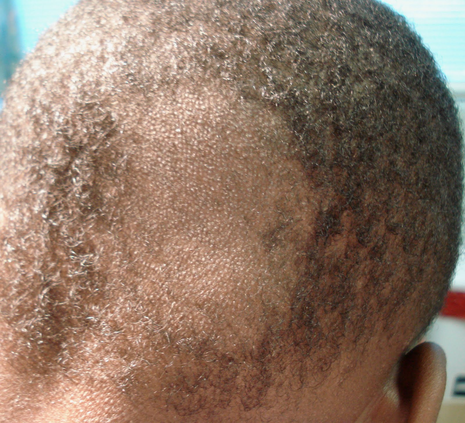 Doctors Gates Between Tinea Capitis And Psoriasis Of The Scalp