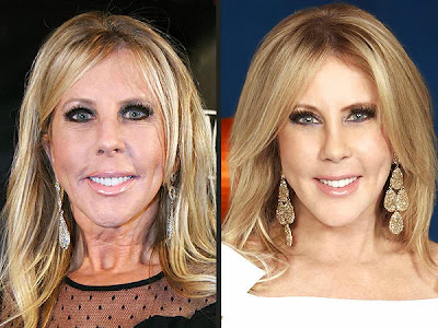 Vicki Gunvalson Before Plastic Surgery