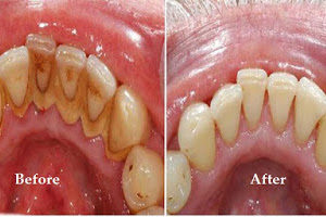How to Remove Teeth Plaque At Home, Tips to Control Tartar