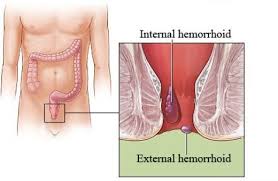 How to Get Rid of Hemorrhoids Fast