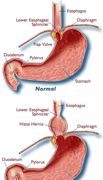 TwoGuys&amp;AGal: GERD &amp; HERNIA...