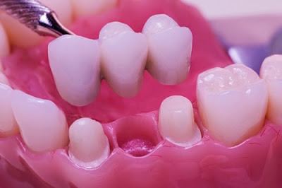 Trồng răng sứ bắc cầu có tốt không? 2