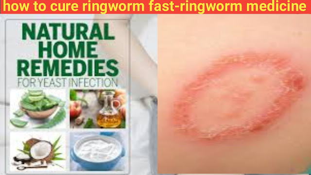 how-to-cure-ringworm-fast-ringworm-medicine.png