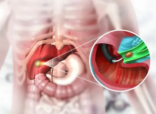 Life After Gallbladder Removal: What You Need to Know