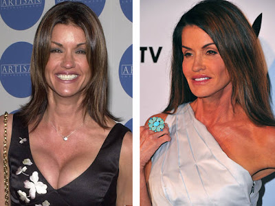 Janice Dickinson Before and After Surgery