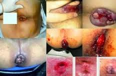 obat wasir alami