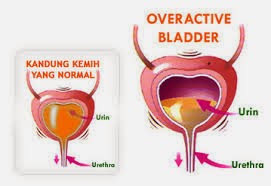 Obat Penghancur Batu Saluran Kemih