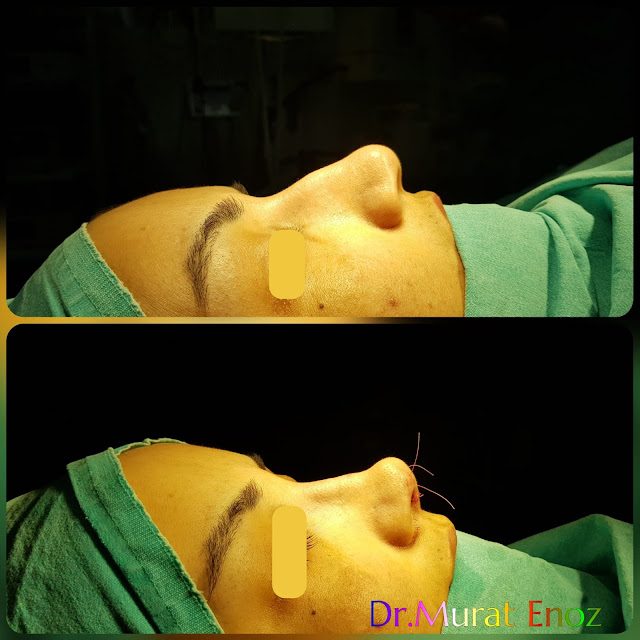 Rhinoplasty 1 month vs 5 Months,Rhinoplasty in Women Istanbul,Female Nose Job,