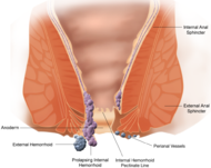 ambeyen hemoroid