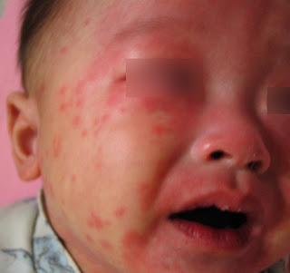 Kawasaki disease rash is one of the rash along with the fever rash pictures