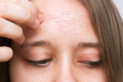 Dry skin