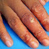 tips menghilangkan gatal eksim di jari tangan