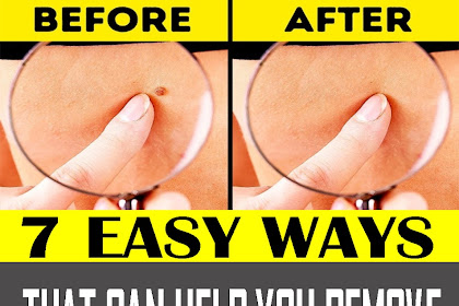 Here Are 7 Easy Ways That Can Help You Remove Skin Tags!!!