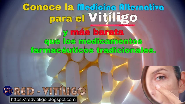 Conoce la medicina alternativa para el vitiligo