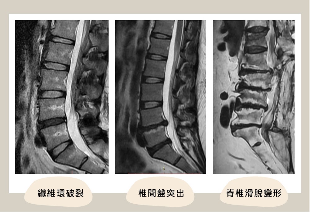 椎間盤核磁共振檢查，可能有椎間盤破裂、椎間盤突出、滑脫變形等