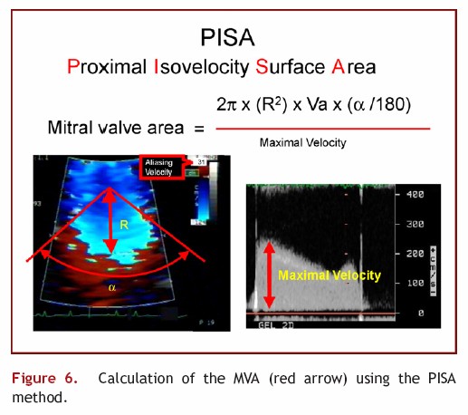 Calculation of the Mitral Valve Area using PISA method on Mitral Stenosis