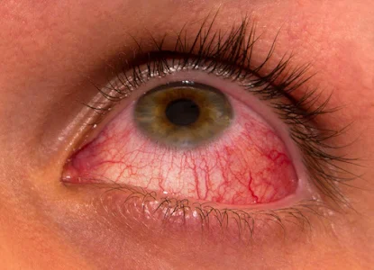 5 Best Ways To Get Rid of Pink Eye Fast Without Eye Drops