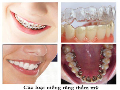 Niềng răng hô hàm dưới không mắc cài