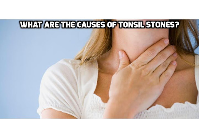 Although the exact causes of tonsil stones are often difficult to determine, tonsil stones often occur when hardened matter builds up in small pockets on the tonsils' surface. 