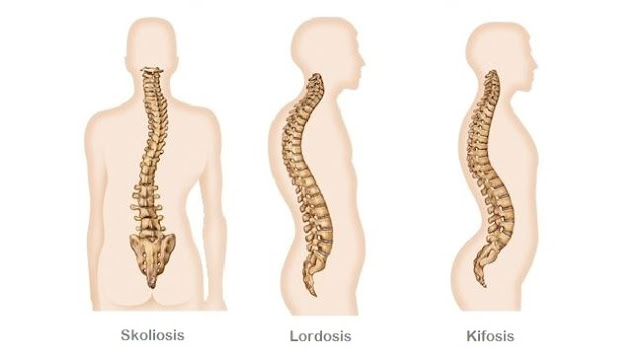 lordosis kifosis dan skoliosis