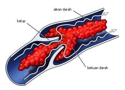 Trombosis Vena