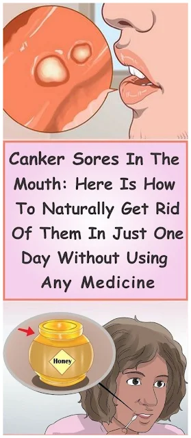 Canker Sores In The Mouth: Here Is How To Naturally Get Rid Of Them In Just One Day Without Using Any Medicine