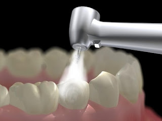 Có nên hàn răng bằng composite cho răng sứt