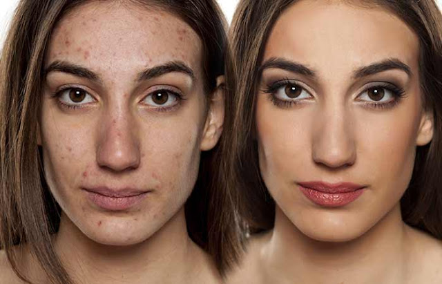 How To Prenvent pinple  on your face? & What causes face pinples  on adults
