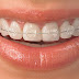 Tìm hiểu về niềng răng mắc cài kim loại