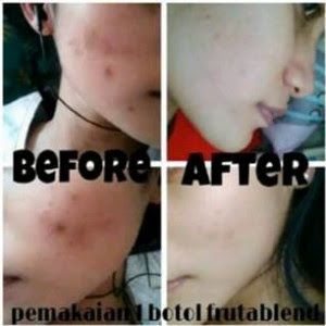 harga obat anti jerawat herbal Palembang