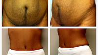 Lower Body Lift Cost