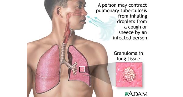 Tuberculosis (TB)