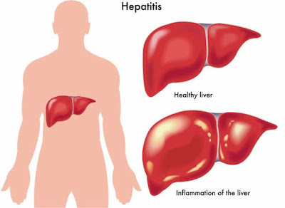 Apa Itu Penyakit Hepatitis