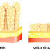 Coeliac disease