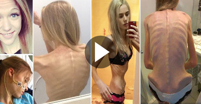 17 Year Teenager Starved Herself And Almost Dies Trying To Become Beautiful!