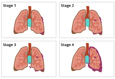 Stages of Mesothelioma Cancer