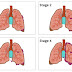 Stages of Mesothelioma Cancer