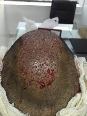 hair transplant in Ludhiana