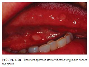 THE PATIENT WITH RECURRING ORAL ULCERS