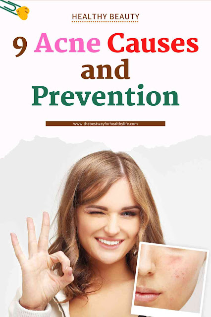 picture acne causes and prevention