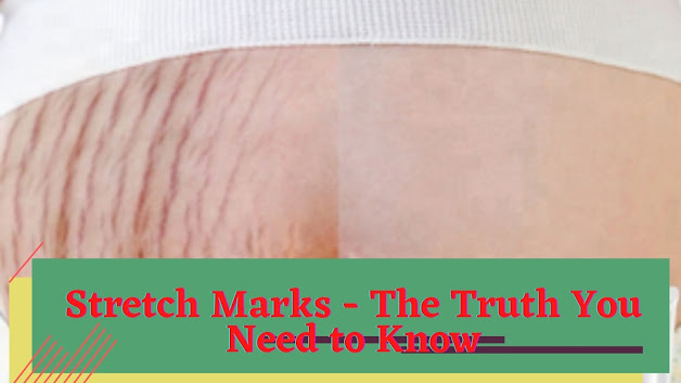 stretch marks during pregnancy images