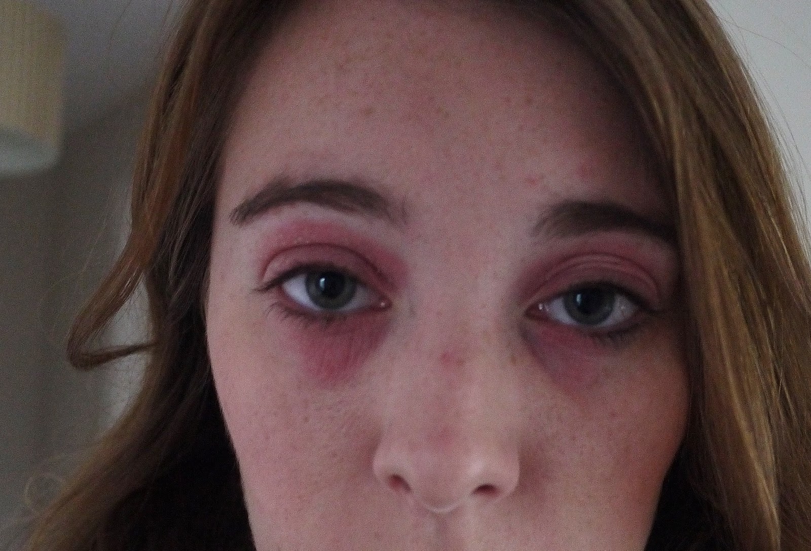 My Struggle With Eye Eczema &amp; My Miracle Cream. | Lux Life 