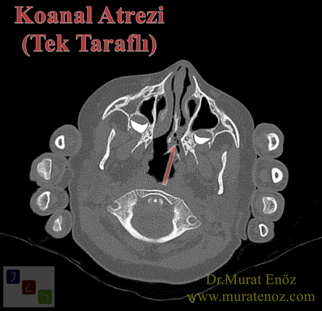 Koanal atrezi nedir? - Koanal atrezi tarihçesi - Koanal atrezi çeşitleri - Bilateral (iki taraflı) koanal atrezi - Tek taraflı koanal atrezi - Koanal atrezi belirtileri - İki taraflı koanal atrezi belirtileri - Tek taraflı koanal atrezi belirtileri - Koanal atrezi neden olur? - Koanal atrezi nedenleri - Koanal atrezi nasıl teşhis edilir? - Koanal atrezi tanısı - Koanal atrezi tedavisi - Koanal atrezi ameliyatı nasıl yapılır? - Koanal atrezi ameliyatı sonrası - Koanal atrezi hemşirelik bakımı - Koanal atrezi emziği (McGovern Emziği - McGovern Nipel) hakkında - Tekrarlayan koanal atrezi