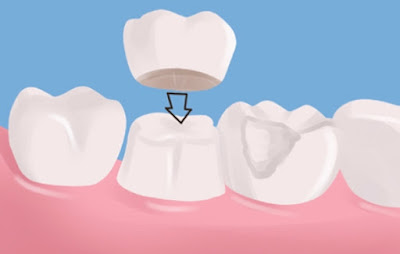 Cách giải quyết răng bị xỉn màu kháng sinh nhanh nhất-2