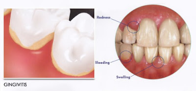 Thông tin về nhổ răng khôn