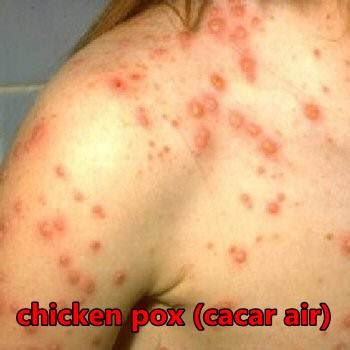 Kesihatan, Kecantikan Dan Petua: APA ITU CHICKEN POX 