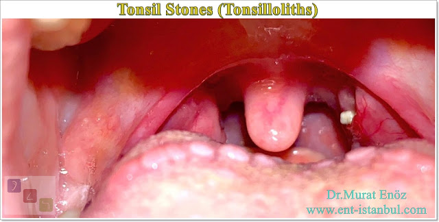 Bad Breath,Tonsil stone,Tonsilloliths,Magma,
