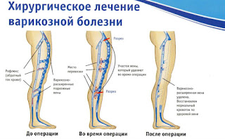 Лечение варикоза Одесса! Форум, отзывы людей, цена, сосудистая хирургия нижних конечностей и флебология в Одессе