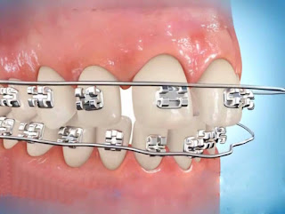Niềng răng hàm trên và hàm dưới