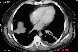 2.- TBC ENTEROPERITONEAL